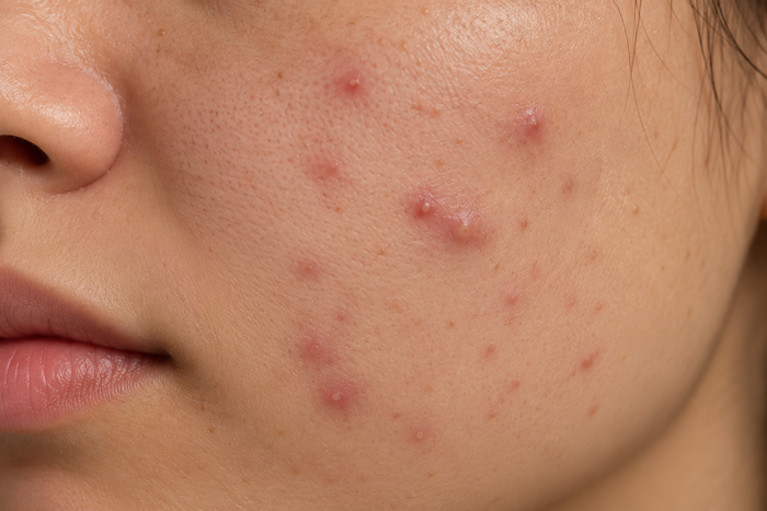 Acne/ breakouts